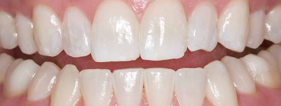 Opalescence Boost in office teeth whitening after