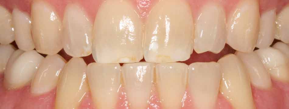 Opalescence Boost in office teeth whitening before